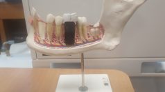 Malý kovový váleček je v podstatě umělý zubní kořen