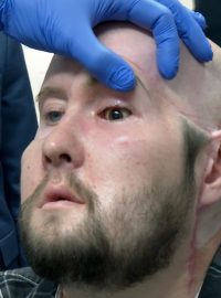 Aaron James po transplantaci oka