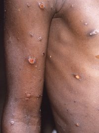 Opičí neštovice (fotografie z roku 1997)