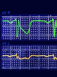 Elektrokardiogram znázorňující infarkt
