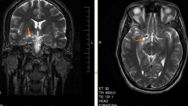 Mozkový nádor typu glioma v počátečním stádiu