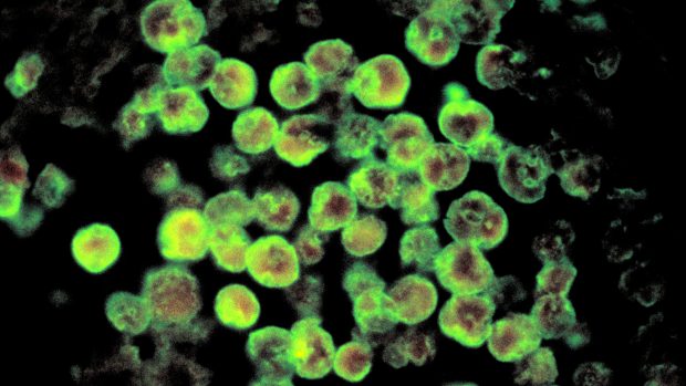 Histopatologie amébické meningoencefalitidy, kterou způsobuje parazit Naegleria fowleri