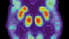 Mozek pacienta trpícího Alzheimerovou chorobou - snímek pořízený pozitronovou emisní tomografií (PET)