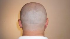 800px-bald_mans_nape_170609-115739_per.jpg