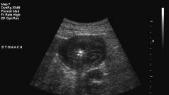 Rakovina žaludku na snímku z ultrazvuku (ilustrační fotografie).