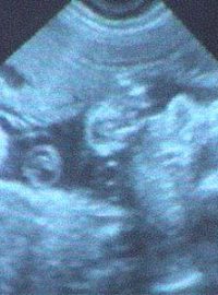 Ultrazvukový snímek lidského plodu