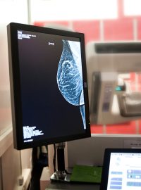 mamografie, vyšetření prsu, ilustrační foto